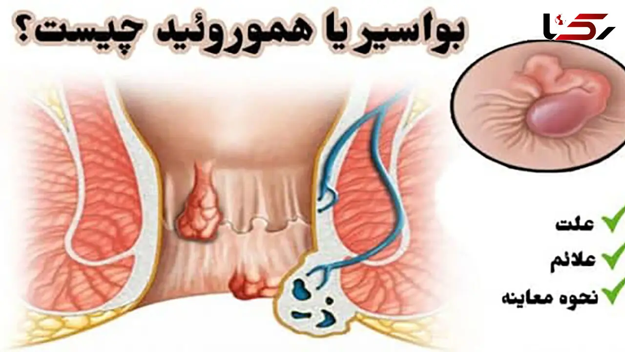 بواسیر چیست؟ / از علائم تا درمان بواسیر