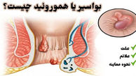 بواسیر چیست؟ / از علائم تا درمان بواسیر