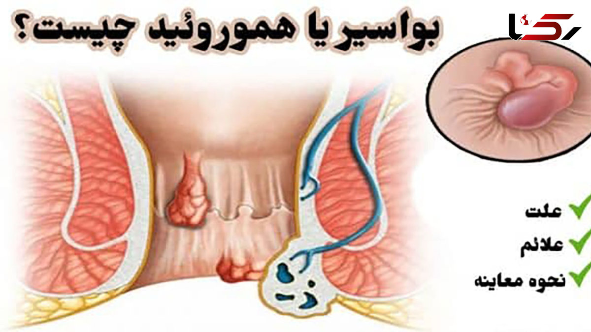 بواسیر چیست؟ / از علائم تا درمان بواسیر