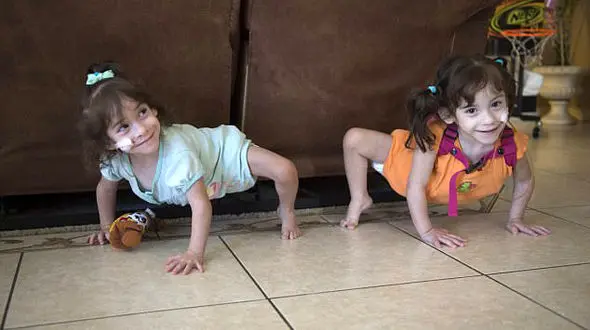 آغاز زندگی جدید برای دوقلوهای به هم چسبیده پس از جراحی موفقیت آمیز + عکس هاس جالب