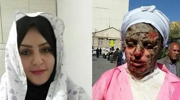  آخرین وضعیت پرونده اسیدپاشی به معصومه در تبریز +عکس
