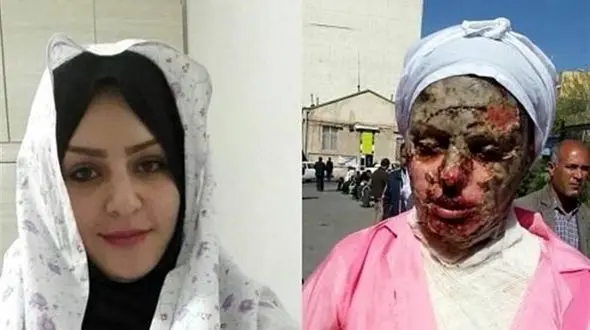  آخرین وضعیت پرونده اسیدپاشی به معصومه در تبریز +عکس