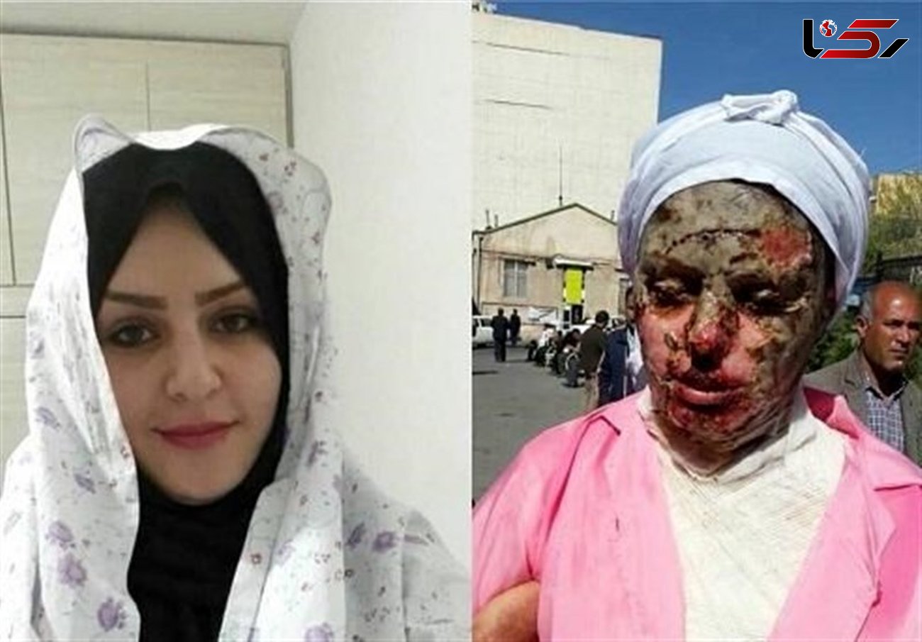  آخرین وضعیت پرونده اسیدپاشی به معصومه در تبریز +عکس