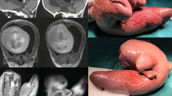 خارج کردن یک جنین مرده از سر بچه ۱ ساله!