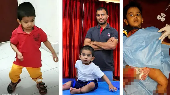 پاهای قطع شده محمد 2 ساله با موفقیت پیوند شد +تصاویر