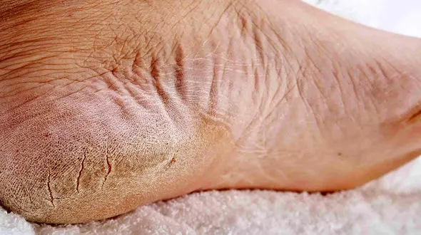 نابودی ترک کف پا با یک روش ساده 