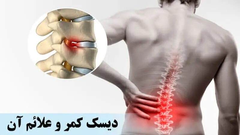 دیسک کمر