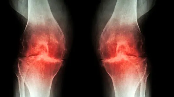 درمان دردهای مفصلی در طب سنتی