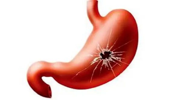 علائم زخم معده + فیلم