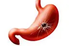 علائم زخم معده + فیلم