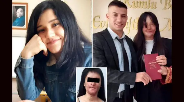 ازدواج یک دختر با پسری که به صورتش اسید پاشید + عکس 