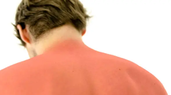  ماده غذایی برای درمان آفتاب سوختگی