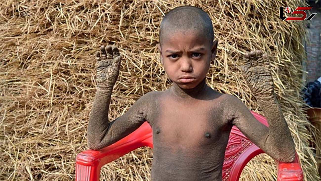 بیماری نادر این پسر بدن او را شبیه سنگ کرده ! +تصاویر