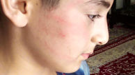 کتک خوردن دانش آموز دبستانی از معلم مدرسه اش در پارس آباد + عکس