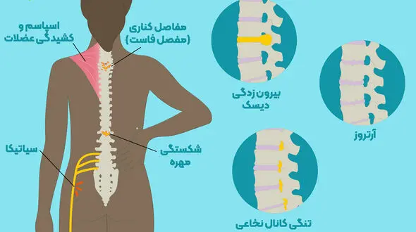 بدترین عادت های زندگی برای کمردرد