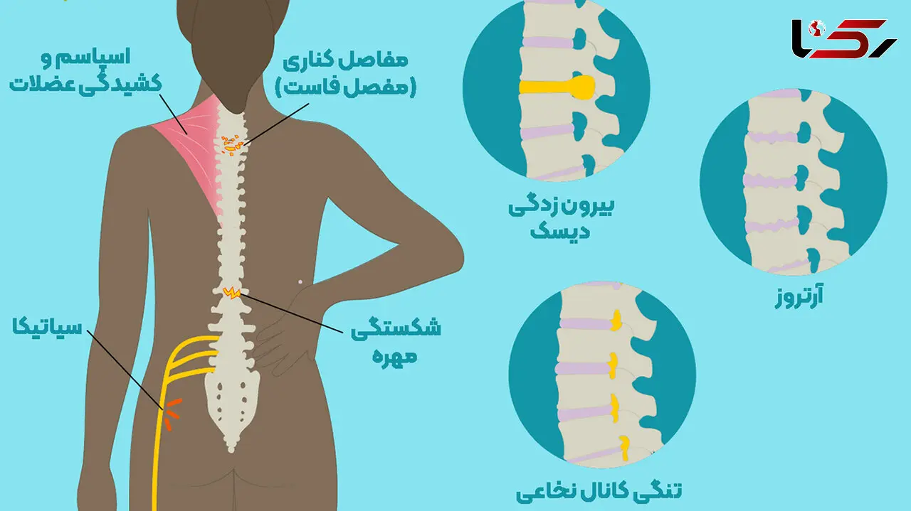 بدترین عادت های زندگی برای کمردرد