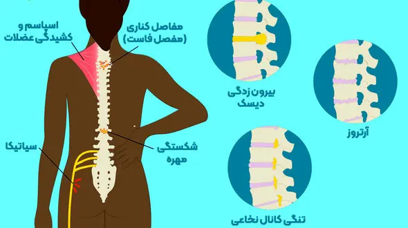 بدترین عادت های زندگی برای کمردرد