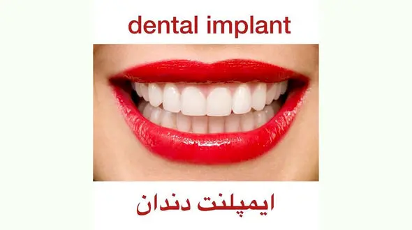 ایمپلنت دندان چیست + فیلم