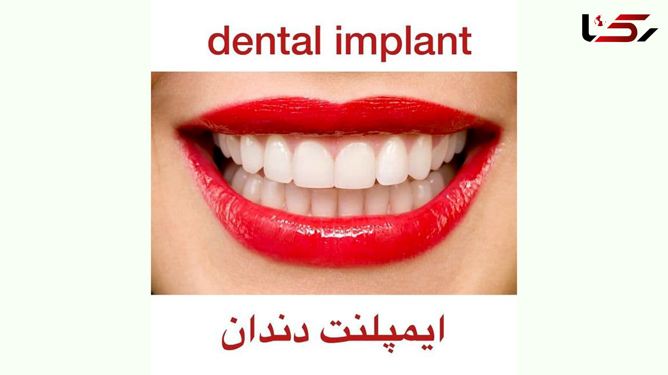 ایمپلنت دندان چیست + فیلم