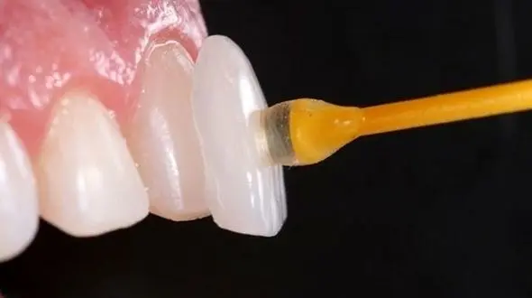  لمینت دندان اقساطی با حداقل پیش پرداخت فقط تا پایان تیر ماه