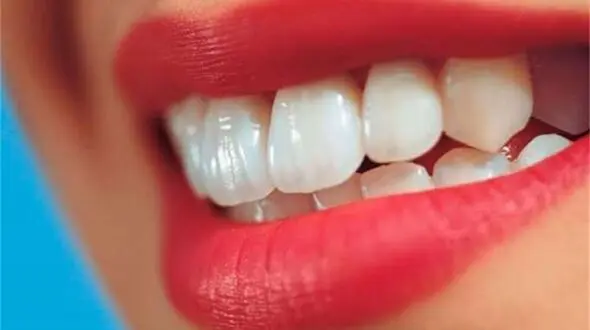لمینت دندان