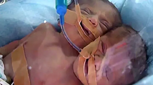 تولد نوزاد دو سر در نواز غزه + فیلم و عکس