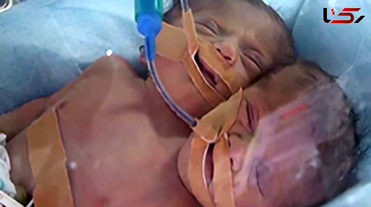 تولد نوزاد دو سر در نواز غزه + فیلم و عکس