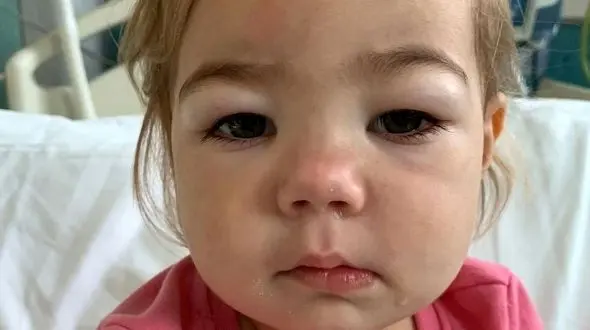  سندرم نفروتیک و بحران سلامت کلیه‌ها در ایران / درمان یا دیالیز؟ 