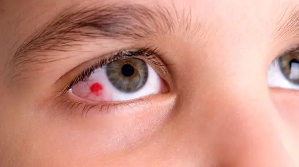  التهاب قرنیه و اختلال در دید 