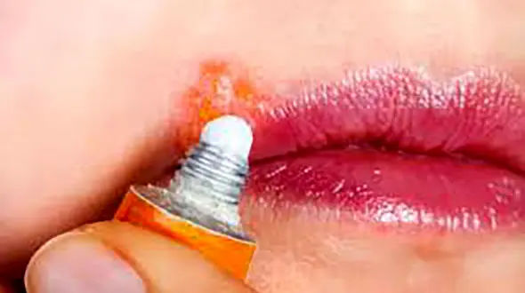 درمان سه سوته تبخال