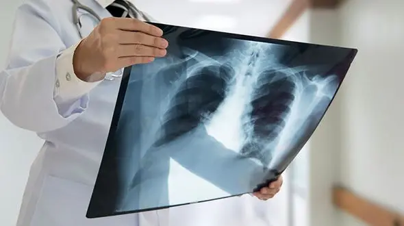 ترمیم بافت ریه در کرونایی ها چقدر طول می کشد؟