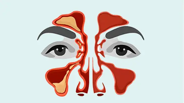 درمان خانگی سینوزیت