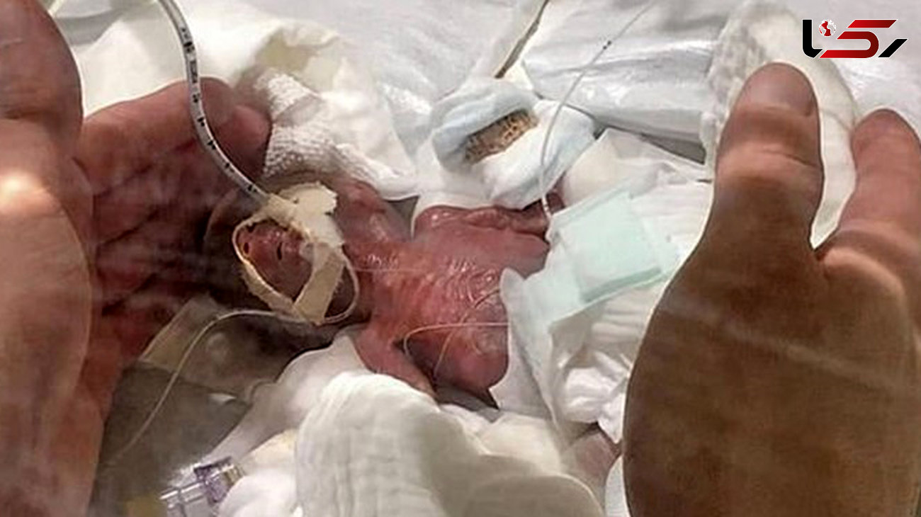 عجیب ترین عکس از تولد کوچکترین نوزاد جهان 