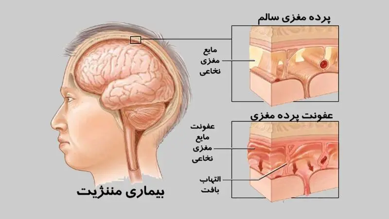 مننژیت