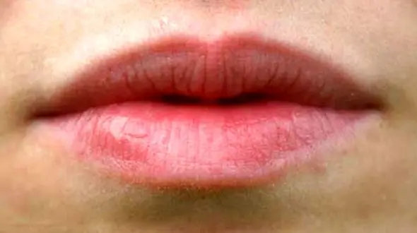 راه های جلوگیری از ترک لب 