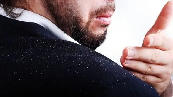 کمبود این ویتامین عامل اصلی شوره سر