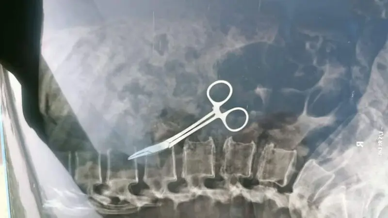 خارج کردن قیچی از شکم یک زن پس از ۲۰ سال