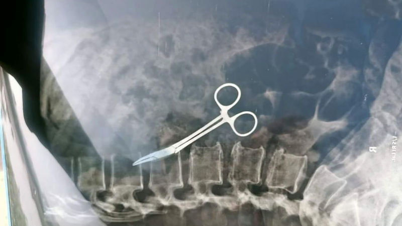 خارج کردن قیچی از شکم یک زن پس از ۲۰ سال