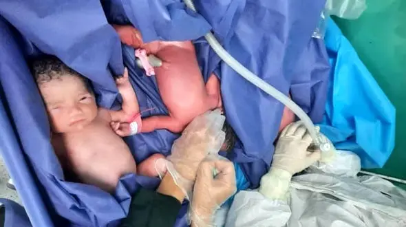 مادرکرونایی در بیمارستان امام رضا(ع) ۳ قلو به دنیا آورد