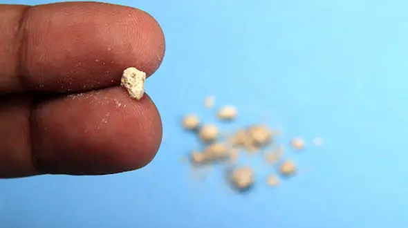 علائم سنگ کلیه را بشناسید + راه های درمان و باورهای غلط