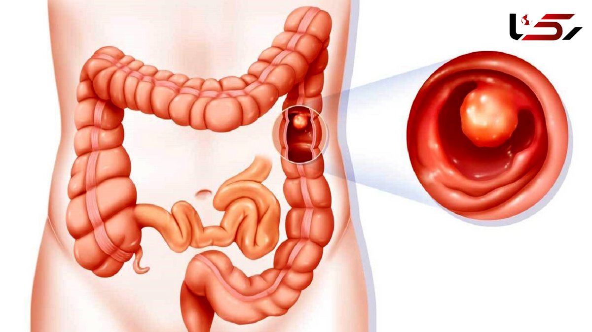 تاثیر رژیم غذایی مناسب در ابتلا به سرطان روده بزرگ 