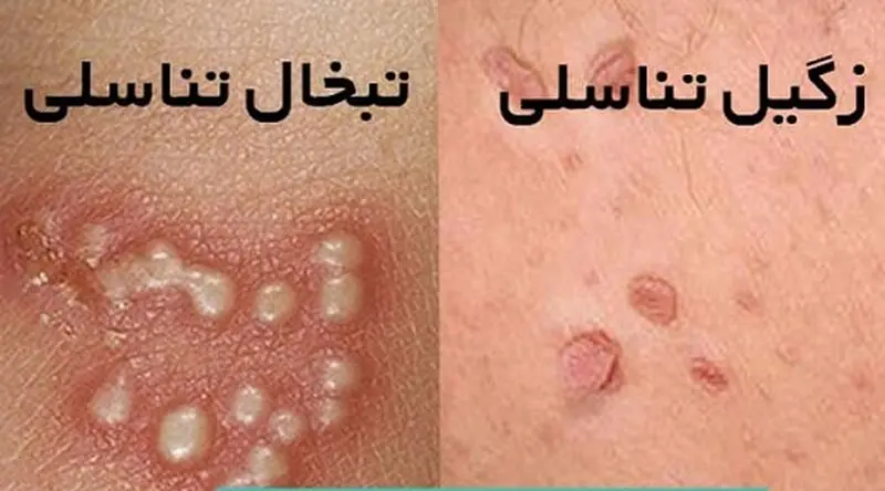 تبخال تناسلی