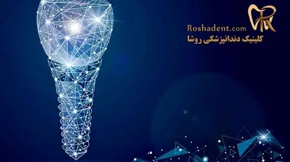 هزینه ایمپلنت دندان در سال 1400 - کاشت دندان فوری
