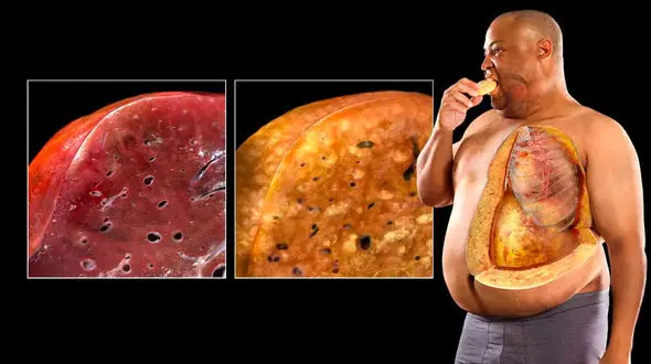 این علائم ساده نشان می‌ دهد شما در یک قدمی کبد چرب هستید