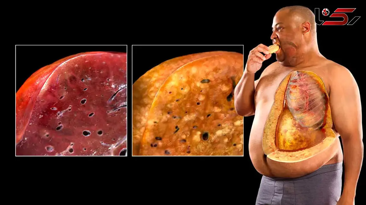 این علائم ساده نشان می‌ دهد شما در یک قدمی کبد چرب هستید