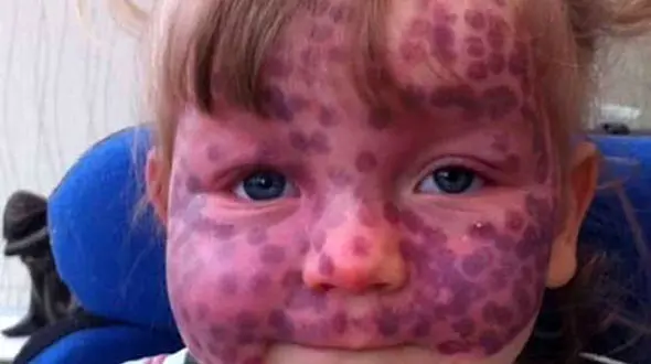  ماه‌گرفتگی نادر روی پوست یک کودک +عکس 