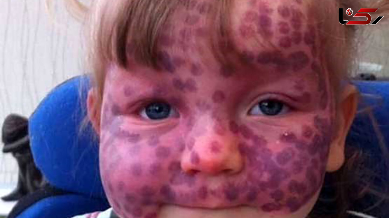  ماه‌گرفتگی نادر روی پوست یک کودک +عکس 