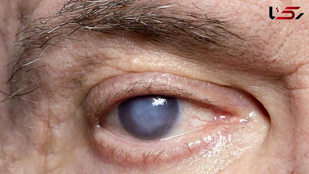چرا چشم‌های بعد از مرگ سفید می‌شود؟ / پاسخ یک کارشناس + فیلم