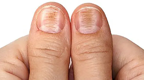 نشانه های سرطان روی ناخن ها