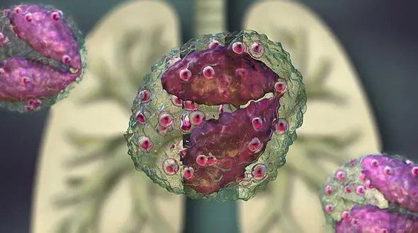 eosinophilia چیست؟ + نقش آلرژی در ایجاد اوزینوفیلیا چیست؟